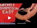 Meckel's Diverticulum Made Easy