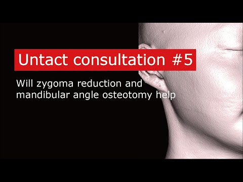 Will zygoma reduction and mandibular angle osteotomy help