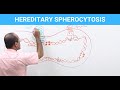 Hereditary Spherocytosis - Diagnosis & Treatment - Genetics
