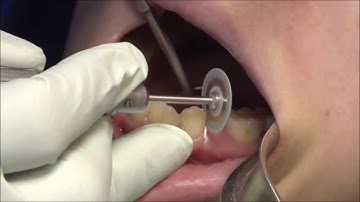 Dentments - How to do IPR