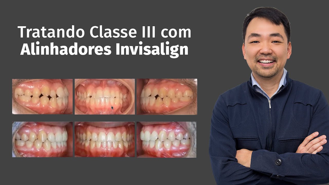 Resolvendo Classe III com Alinhadores Invisalign 