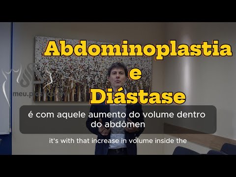Abdominoplastia e diástase: flacidez abdominal