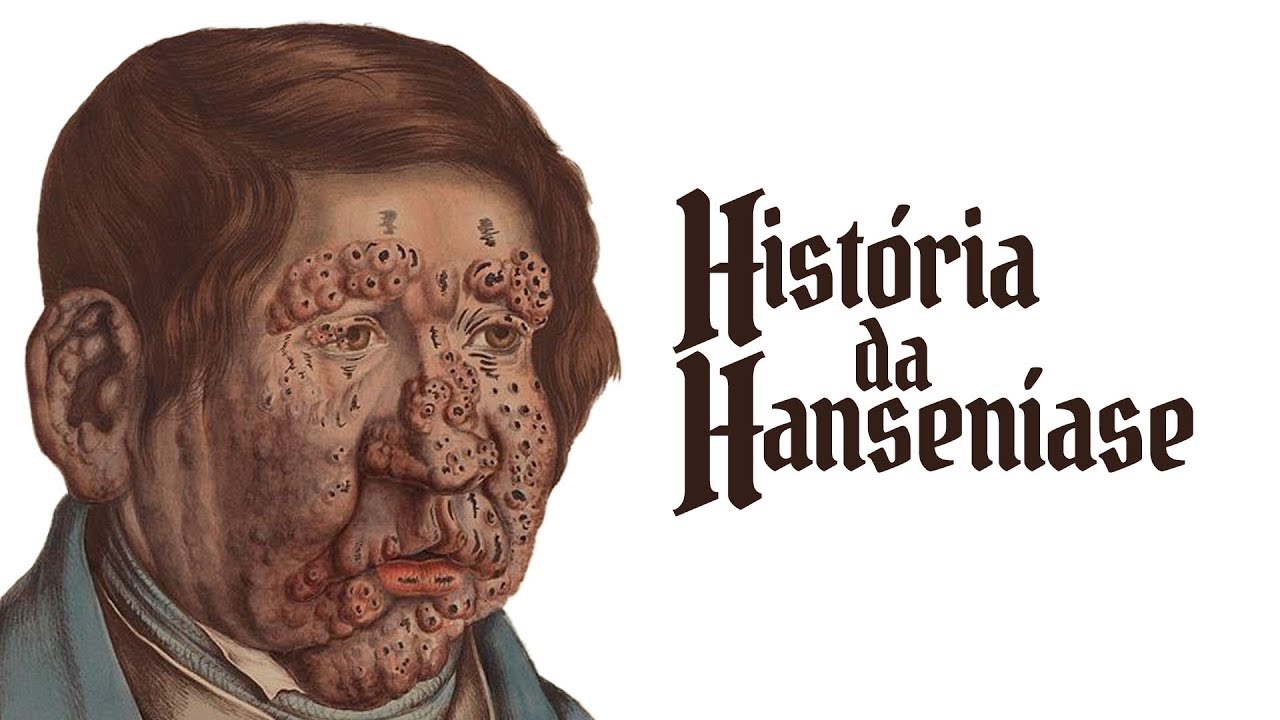 Hanseníase: uma das doenças mais antigas da humanidade
