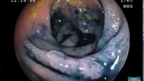 Macroscopic Features of Submucosal Invasion in Colorectal Lesions