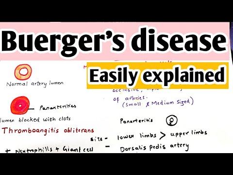 Buerger&rsquo;s disease | Thromboangitis obliterans | Definition, causes, pathophysiology, treatment