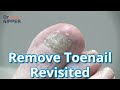 Is Toenail Removal Painful?  In Spanish. Revisited. FEET-ure Friday (2021)
