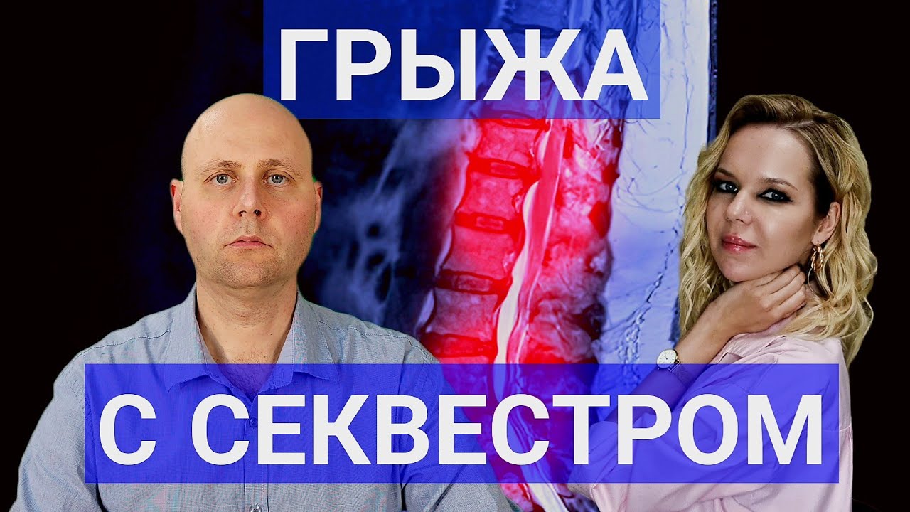 Секвестрированная грыжа позвоночника
