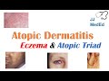 Eczema atopic dermatitis  atopic triad triggers who gets it why does it happen  treatment