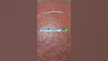 1st session of #smp #microscalp #xămtóc  #scalpmicropigmentation