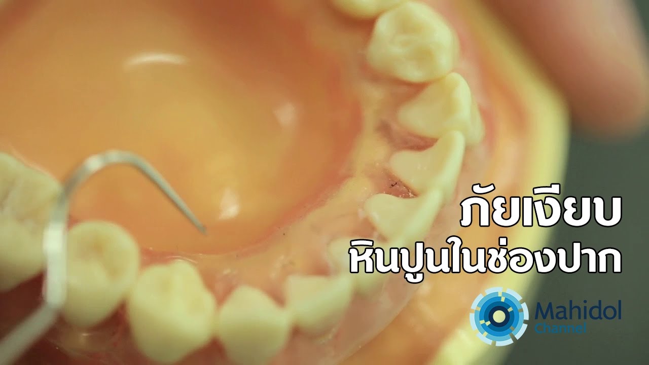 คลิป MU [by Mahidol] ภัยเงียบ หินปูนในช่องปาก