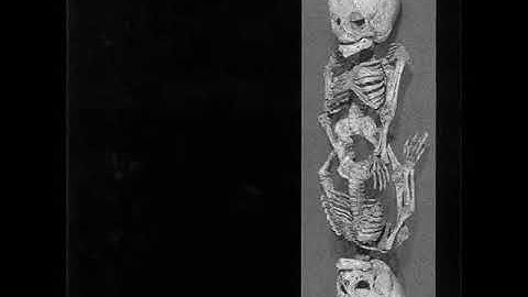 Atom Infant Incubator - Segment 0-1