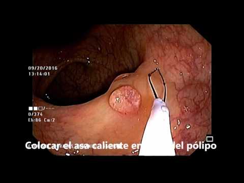Video: Polipectomia: Procedura Chirurgica E Recupero