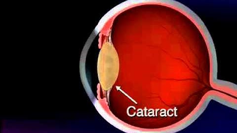 What is a cataract