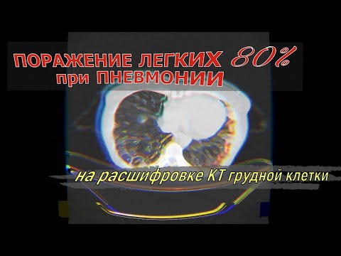 Полисегментарная вирусная ПНЕВМОНИЯ КТ 4 с ПОРАЖЕНИЕМ ЛЕГКИХ 80 процентов на КТ ВТОРОЕ МНЕНИЕ