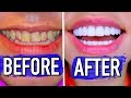 The truth about how I fixed my smile! Veneers Experience