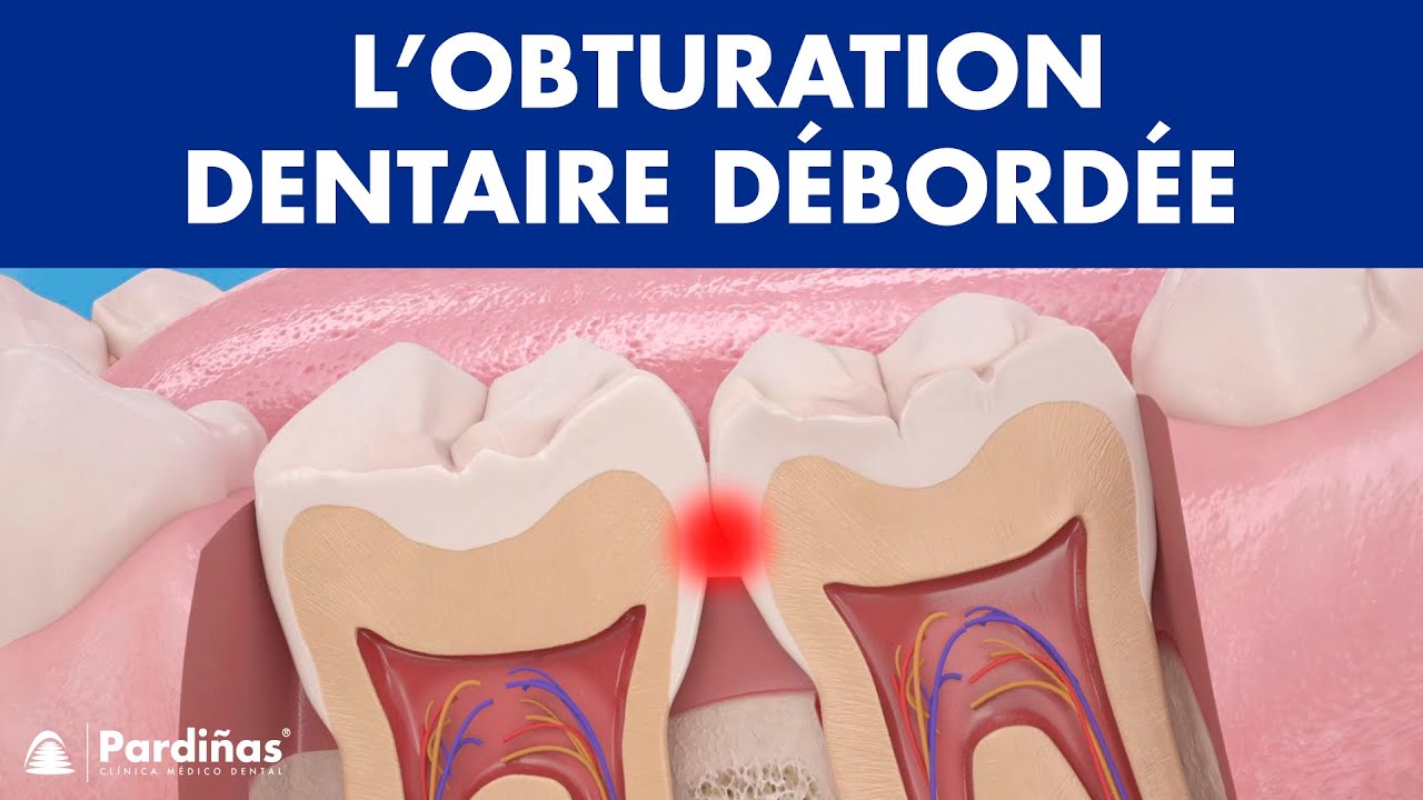 Problèmes de plombage dent – L'obturation dentaire débordée © 