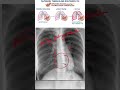 Pulmonary Tuberculosis X-Ray Explained in 60 Seconds 🫁 #anatomy #xray