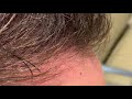 Dallas Hair Transplant CloseUp Result