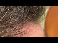 Dallas Hair Transplant CloseUp Result