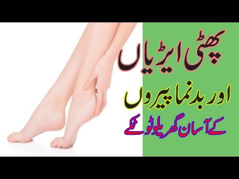 Cracked heels treatment at home - Cracked heels home remedy in urdu