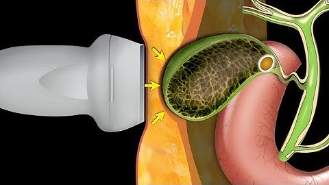 Ultrasound of Biliary Colic