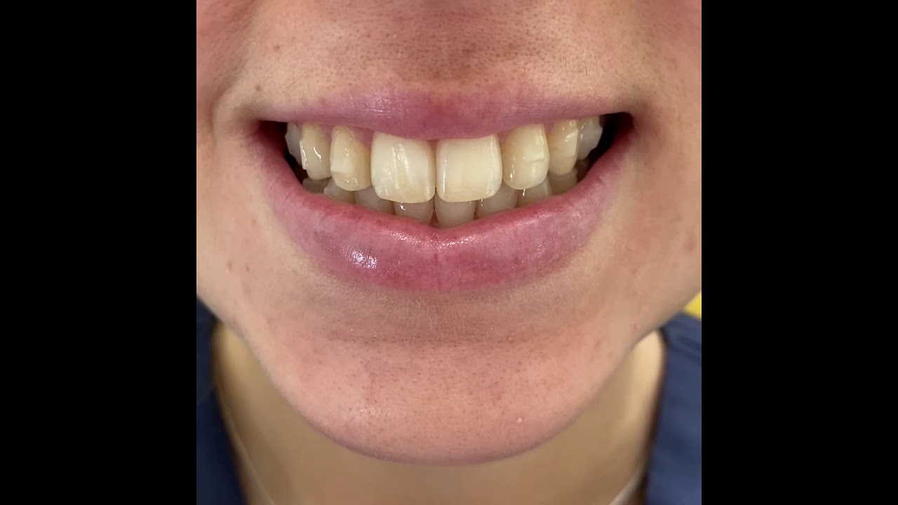 How to fit and remove clear aligners - YouTube