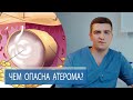 ЧЕМ ОПАСНА АТЕРОМА? | Лечение жировика атеромы