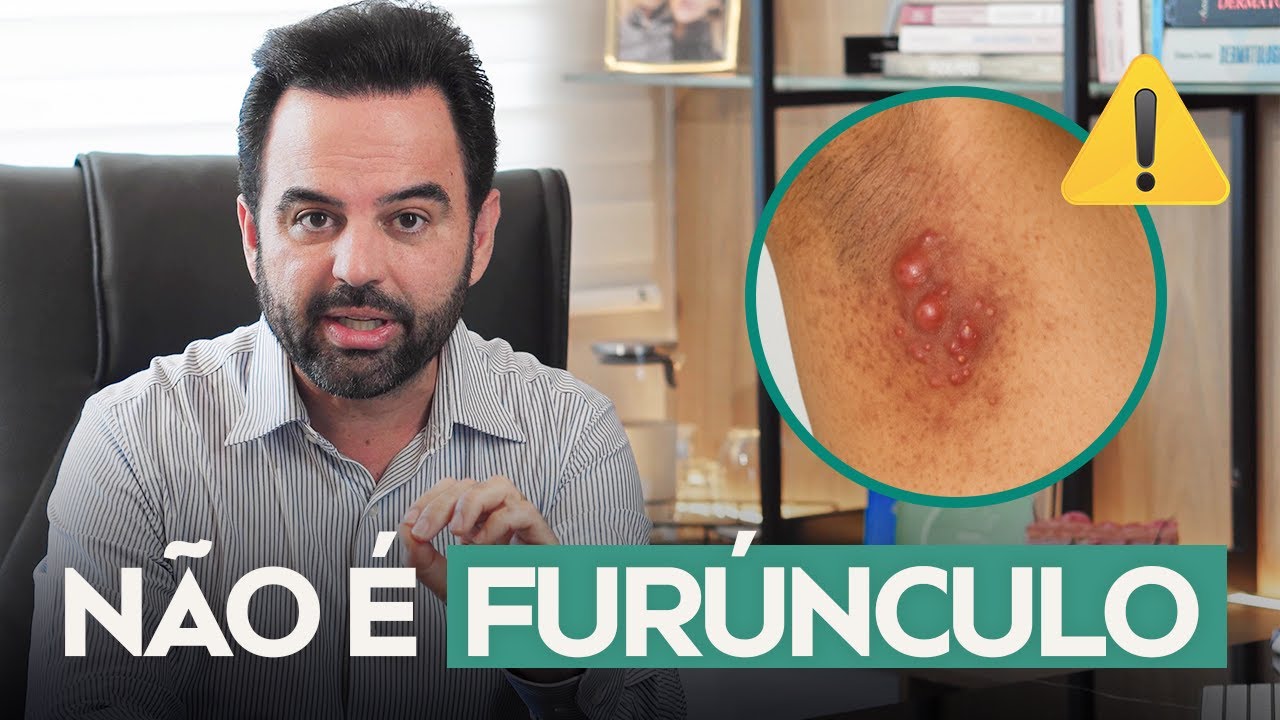 Furúnculos que não melhoram? - Hidradenite Supurativa