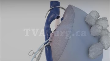 Extended right hepatectomy with in situ cold perfusion