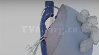 Extended right hepatectomy with in situ cold perfusion