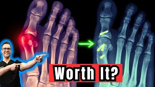 Big Toe Surgery Worth It? [Bunion, Hallux Rigidus & Osteoarthritis]