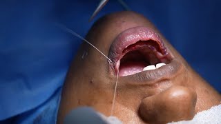 Lip reduction Complete Surgery - Dr. Sunil Richardson