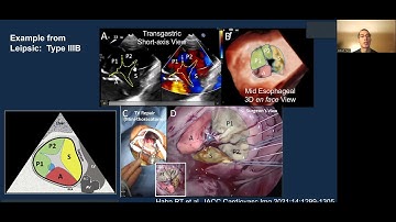 Lecture: Tricuspid Valve TEE Screening for Transcatheter Edge-to-Edge Repair (TEER)