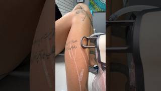 Scars Removed By Laser