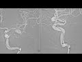 Y configuration stent assisted coil embolization of MCA bifurcation unruptured aneurysm