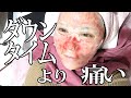【鼻整形前にダーマペンしながら愚痴る】でも美容整形ってハマっちゃうんだよな。
