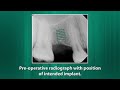 Twostage implant placement for a congenitally missing maxillary premolar