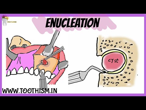 Surgical Management of Cysts of the jaw | ENUCLEATION of a cyst | Oral Surgery