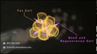 Stem cells therapy for breast cancer treatment