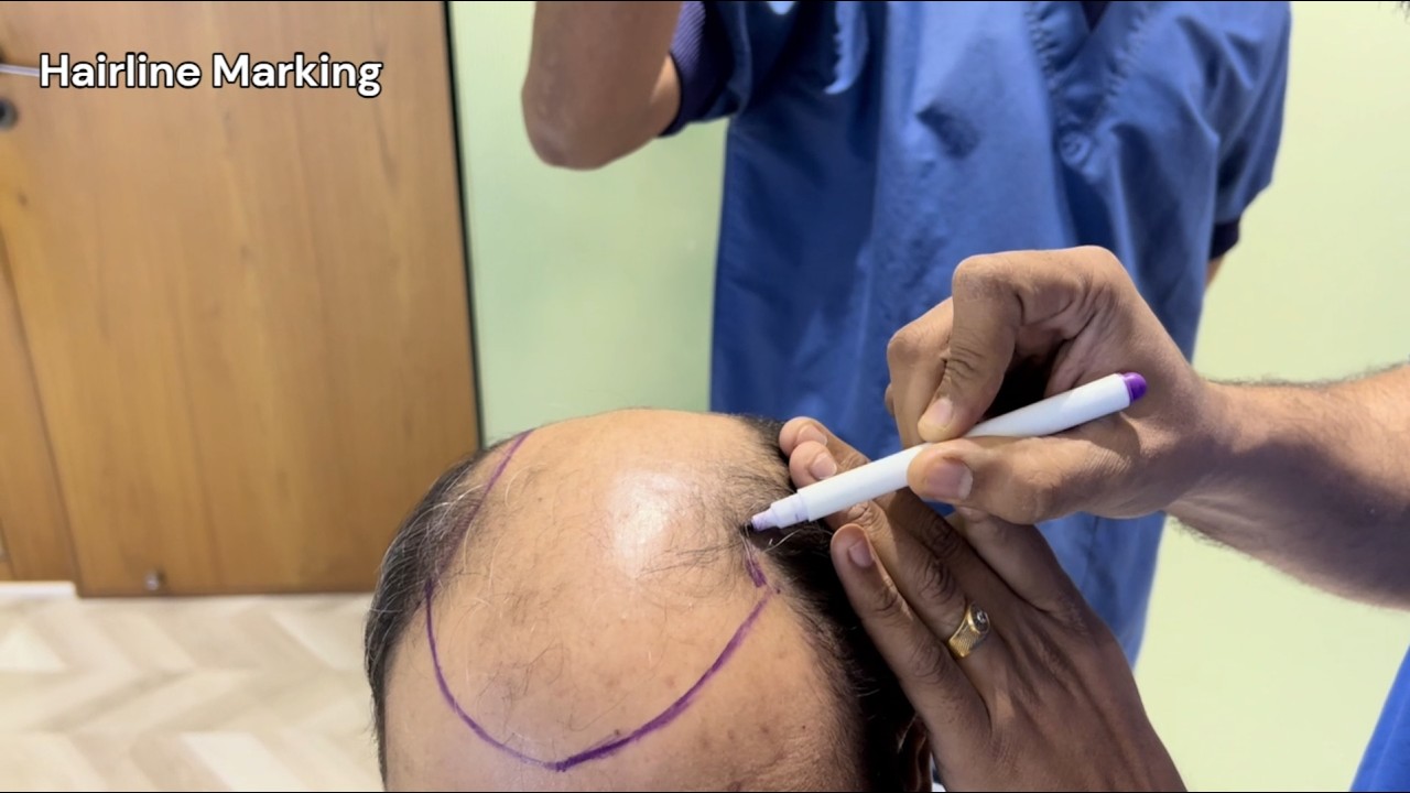 Hair Transplant Hairline Marking Process | Designing a Natural Hairline | Bellisima Clinic Ahmedabad