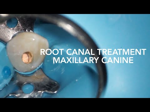 Root Canal Treatment On Maxillary Canine