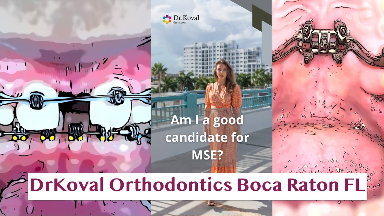MARPE and MSE treatment DrKoval Orthodontics Boca Raton