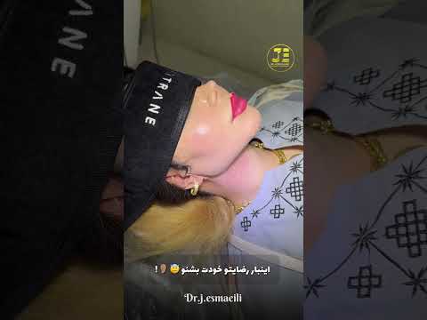 سوپرکانتورینگ غبغب سوپرکانتورغبغب غبغب ساکشن 