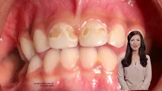 Treatment of Baby Bottle Tooth Decay in Brisbane