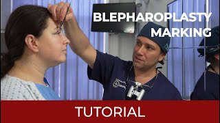 Eye Lift Marking Tutorial (Blepharoplasty) Transform Eyelids With Precision A Step By Step Blepharoplasty Marking Guide