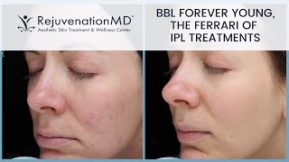 Why is BBL Forever Young the Ferrari of IPL Treatments?