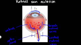 Retinal vein occlusion