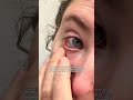 Scleral Lenses Changed My Life