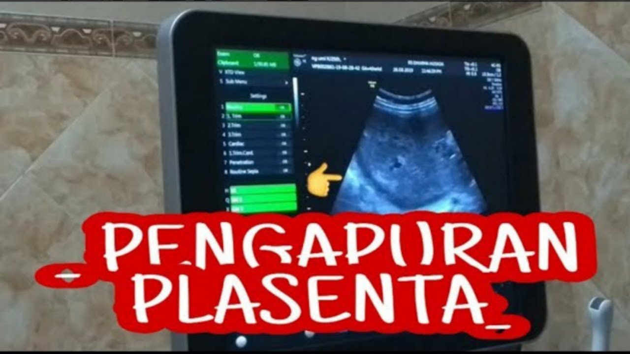 BAHAYA PENGAPURAN PLASENTA YouTube BAHAYA PENGAPURAN PLASENTA YouTube