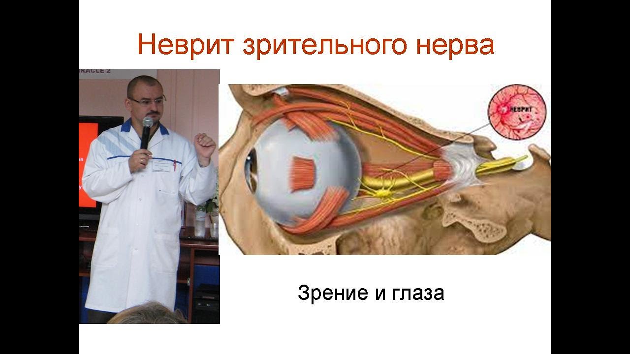 Неврит зрительного нерва. Его проявление и лечение. - YouTube